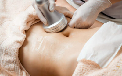 Sculpsure vs CoolSculpting: Which is Better for You?