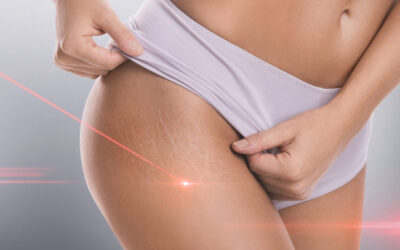 How to Permanently Remove Stretch Marks