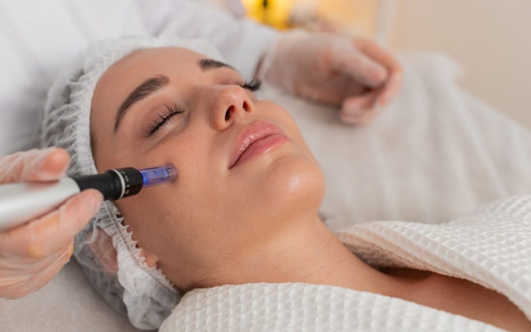 PRP Microneedling: What It Is, How It Works, and Why Women Love the Results
